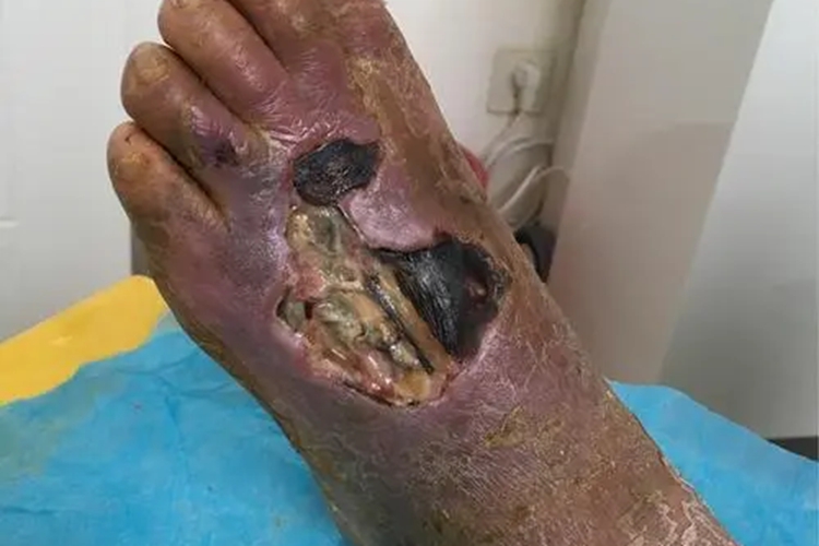 Ⅳ级糖尿病足症状图