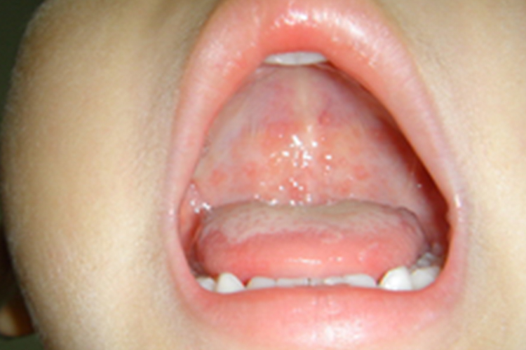 原发性疱疹性口炎前驱期图