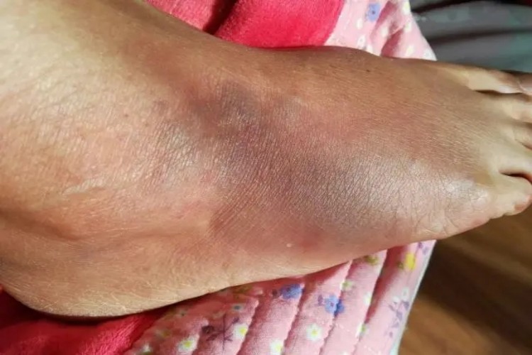 轻度扭伤脚背红肿图