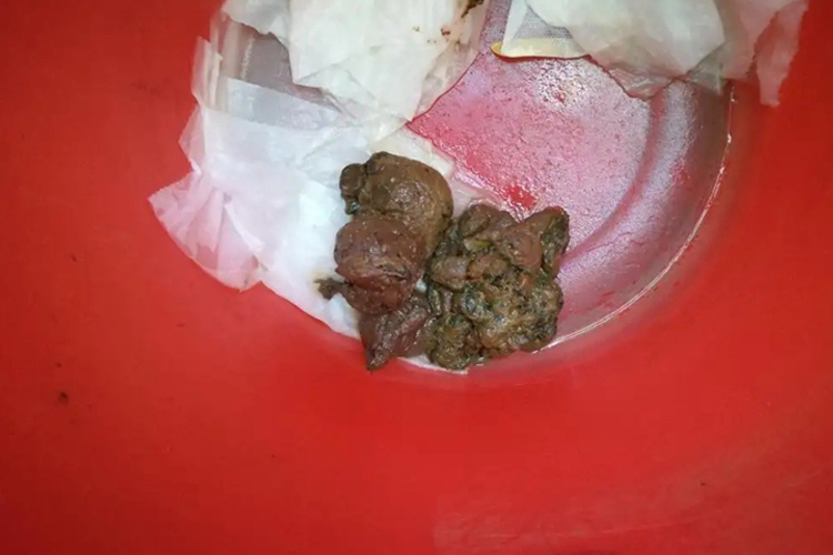 痔疮大便有红色肉状物图