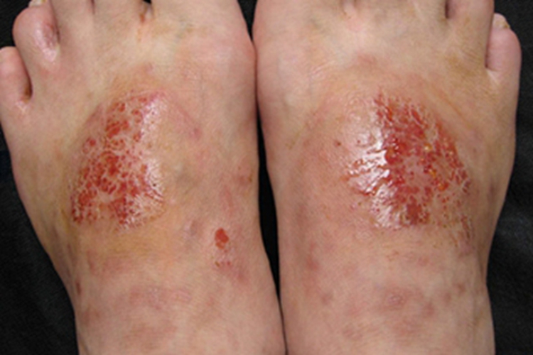 皮肤过敏红肿脚背糜烂图 皮肤过敏红肿脚背糜烂图