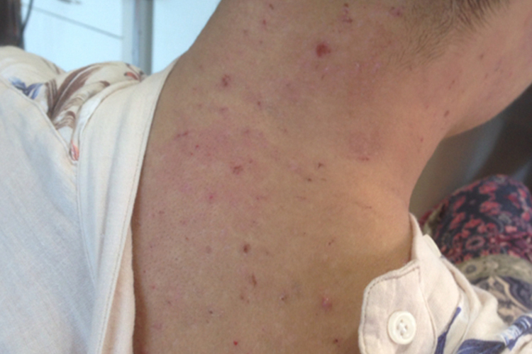 男人后背湿疹图