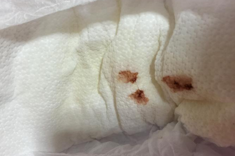 新生儿假月经图 新生儿假月经图