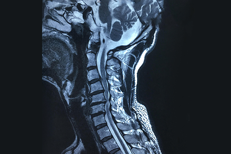 脊髓型颈椎病图