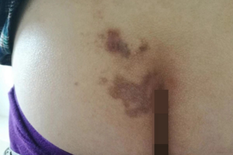 扁平苔藓臀部紫斑图