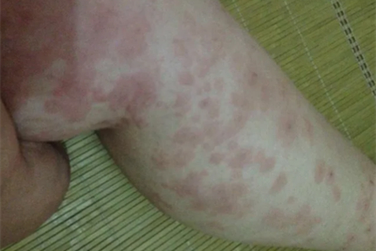 色素性荨麻疹腿症状图 色素性荨麻疹腿症状图