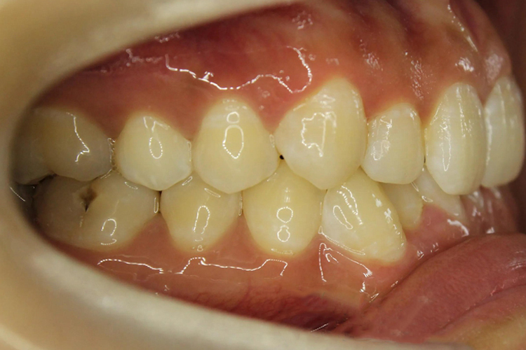 下排牙齿向内倾斜图片_有来医生