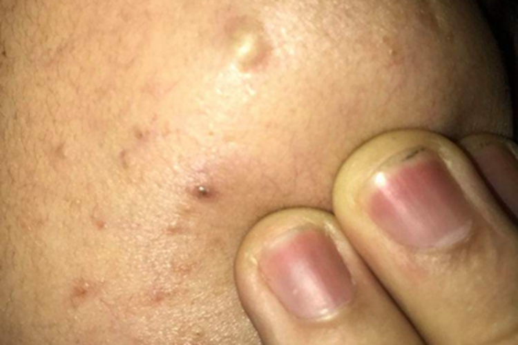 网状组织细胞肉芽肿症状图 网状组织细胞肉芽肿症状图