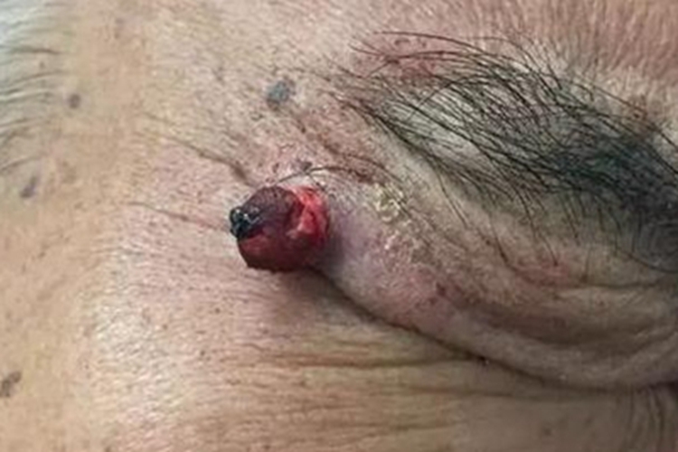 化脓性肉芽肿肉球图