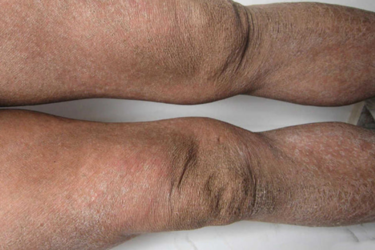 大腿内侧寻常型鱼鳞病图