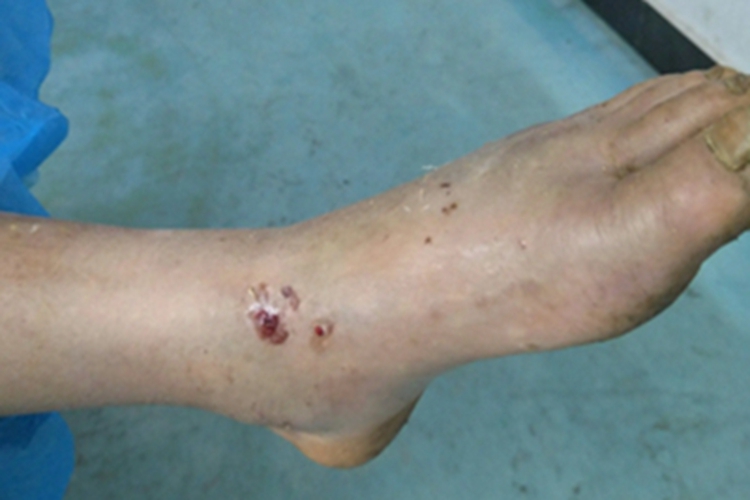 蛇咬伤脚踝小孔图 蛇咬伤脚踝小孔图
