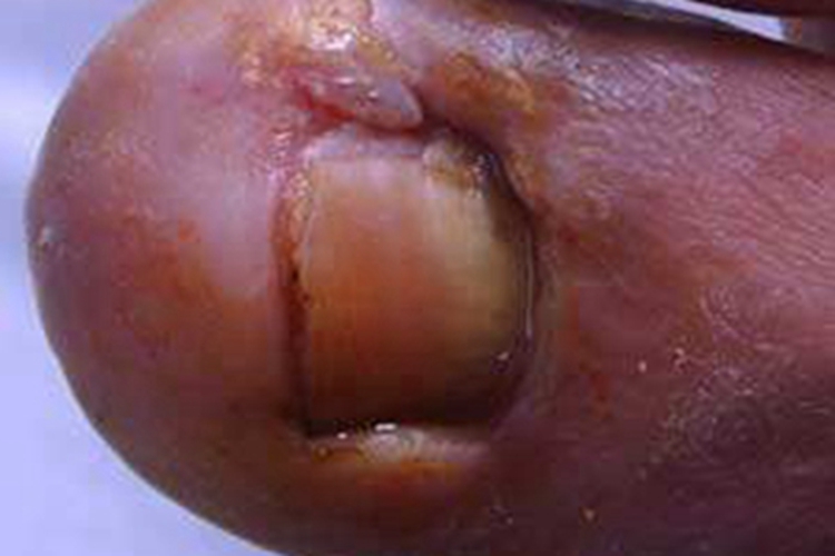 慢性化脓性甲沟炎红肿图