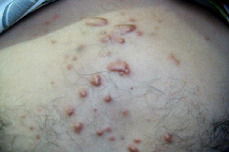 浅表性皮肤脂肪瘤痣红斑图