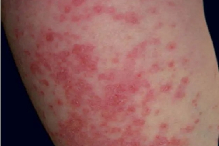 急性皮肤型红斑狼疮大腿脱皮图