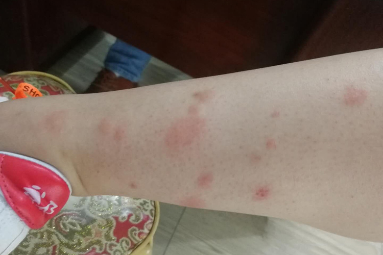 黑芝麻过敏荨麻疹图 黑芝麻过敏荨麻疹图