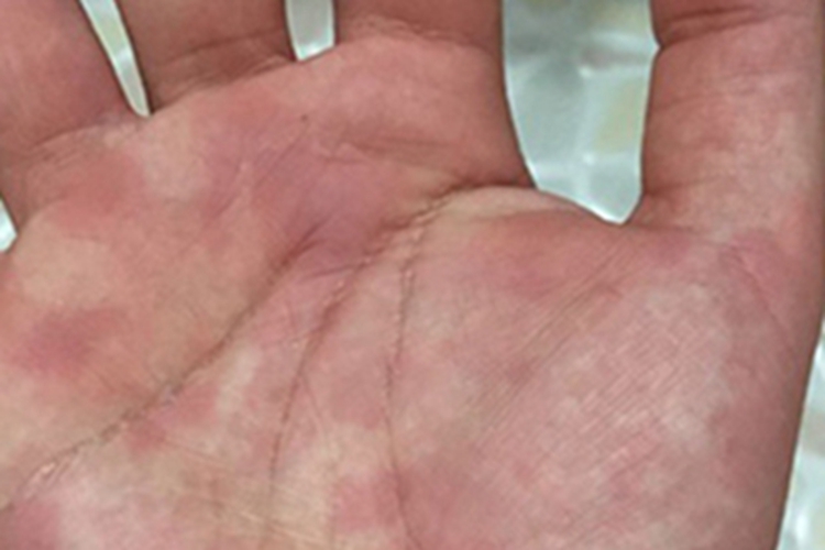 荨麻疹手掌症状图 荨麻疹手掌症状图