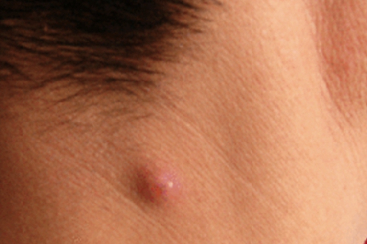 皮脂腺瘤早期症状图
