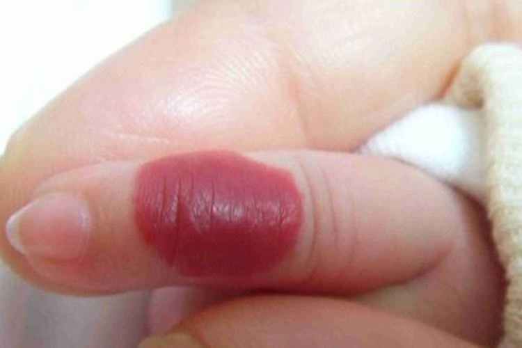 手指上单纯血管瘤图