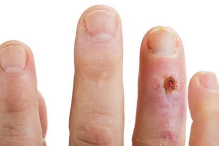 蜂窝织炎手指发红图