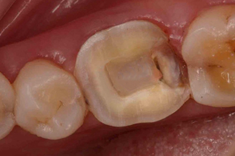 酸蚀症牙齿缺损发黄图