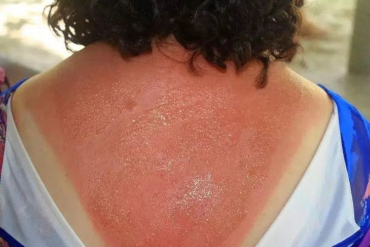 光接触性皮炎背部红斑图 光接触性皮炎背部红斑图