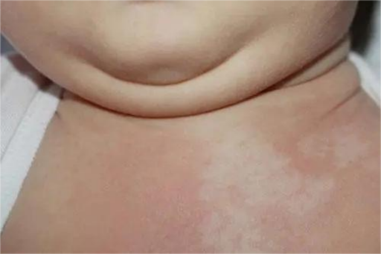 新生儿皮肤花斑图片