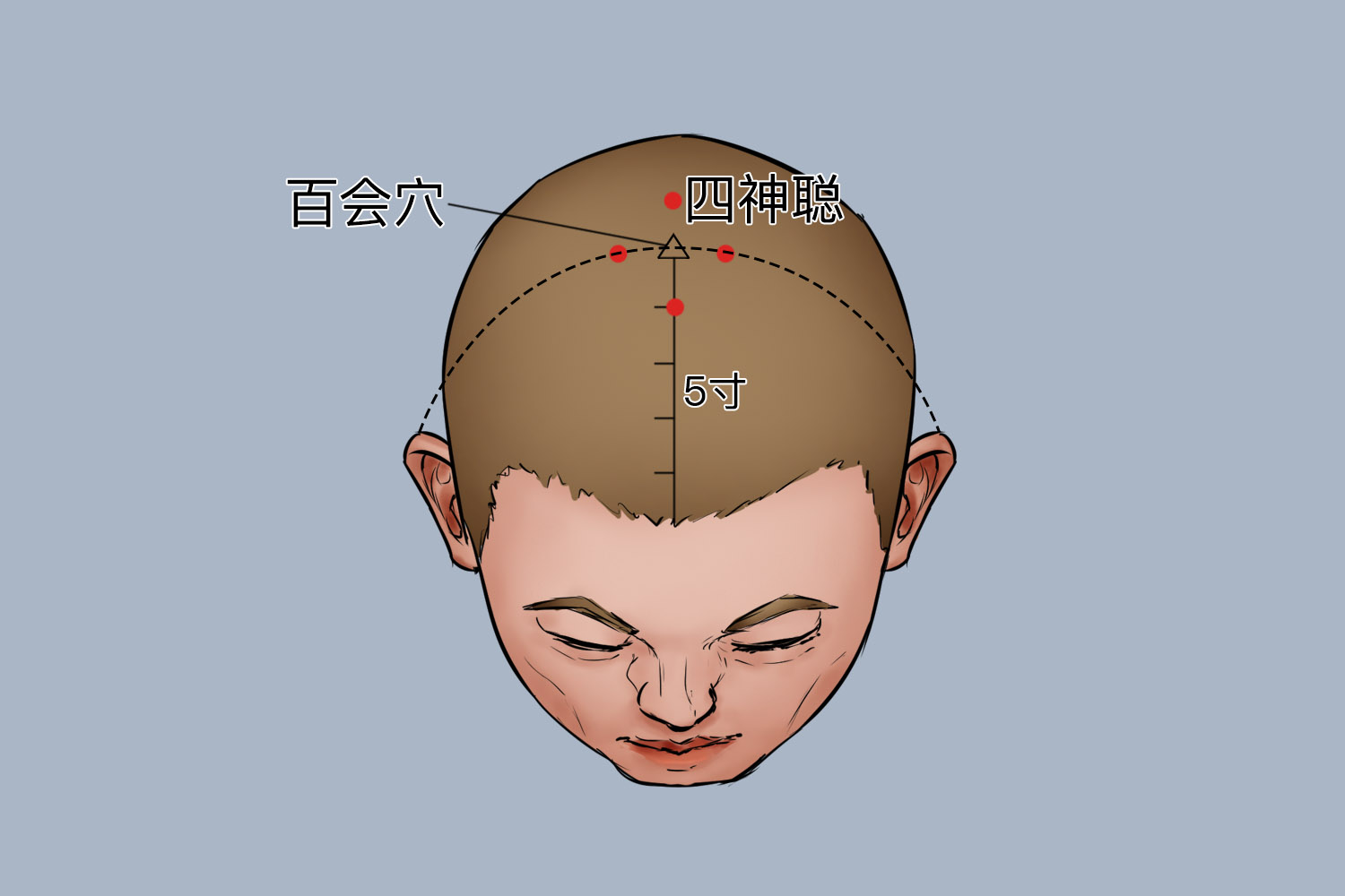 四神聪穴位置图 四神聪穴位置图