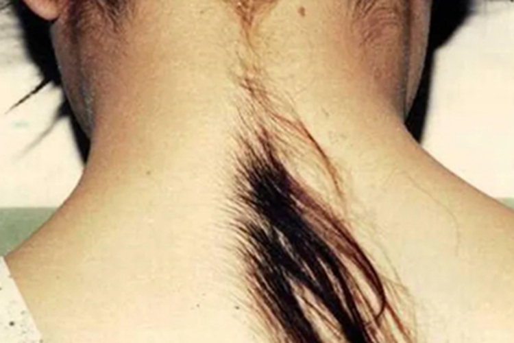 女性多毛症后颈症状图