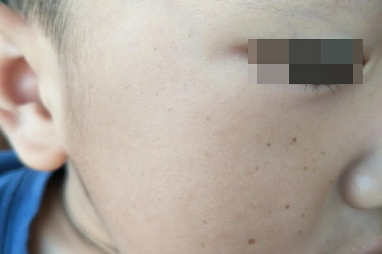 儿童雀斑图 儿童雀斑图