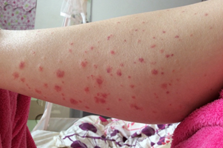 暴发性紫癜红点图