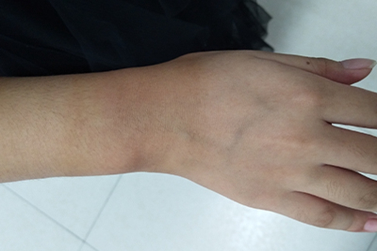 跌伤手腕淤紫图