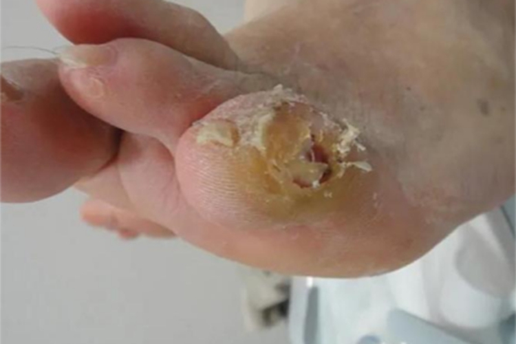 胼胝脚部症状图