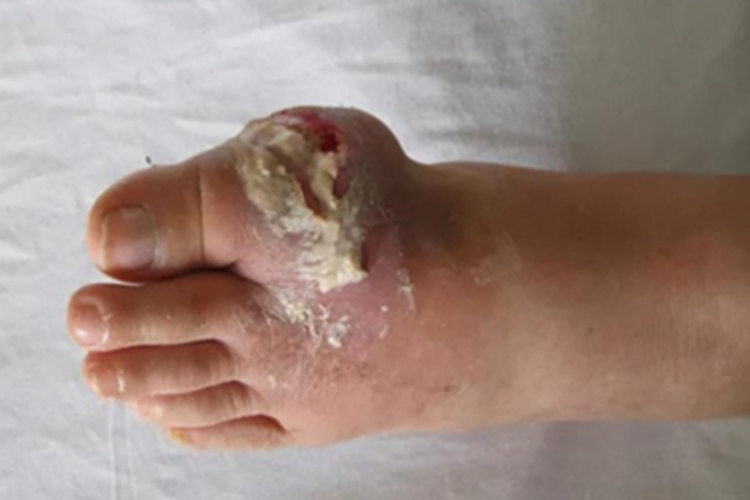 痛风脚趾痛风石图