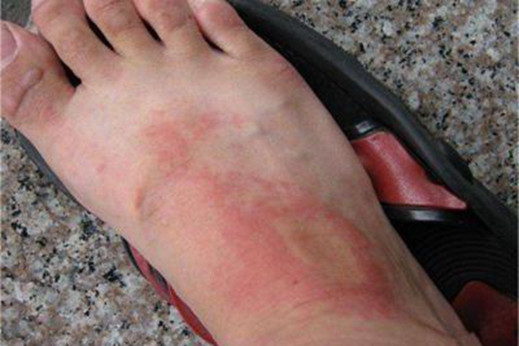 Ⅰ度冻伤脚部症状图