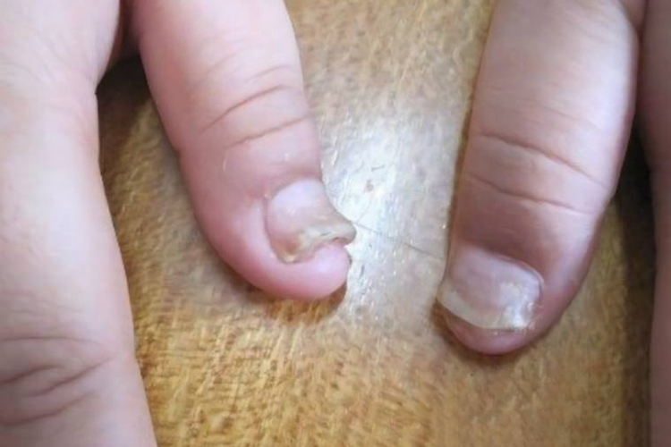 甲真菌病症状图