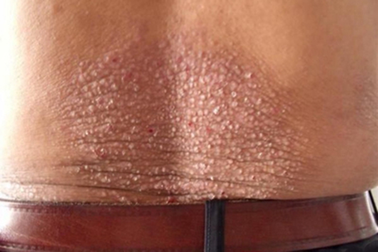 苔藓样淀粉样变病腰部症状图