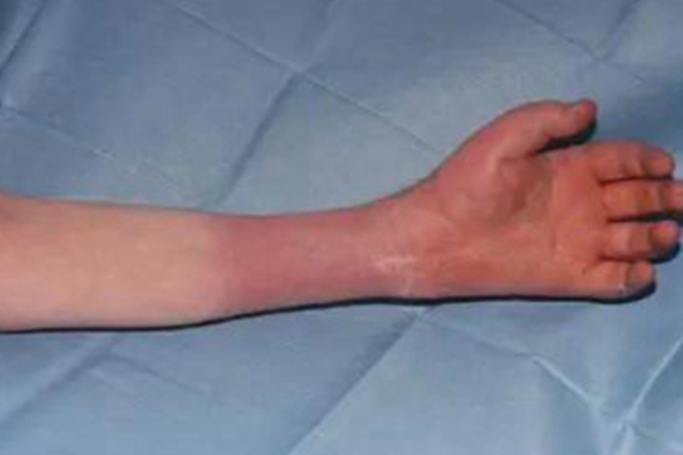 淋巴水肿红肿图