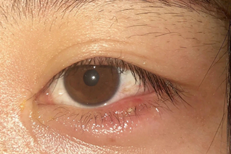 外睑腺炎症状图