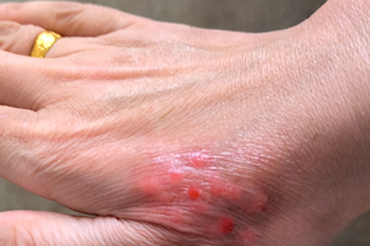 痒疹手部症状图