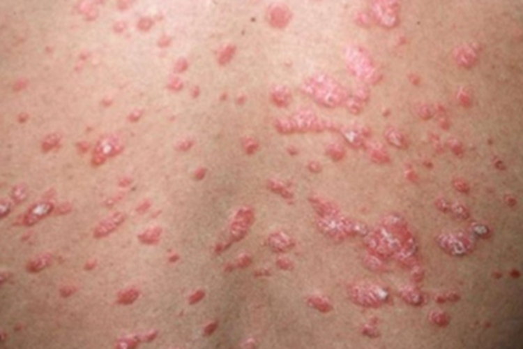 自体敏感性湿疹背部丘疹图