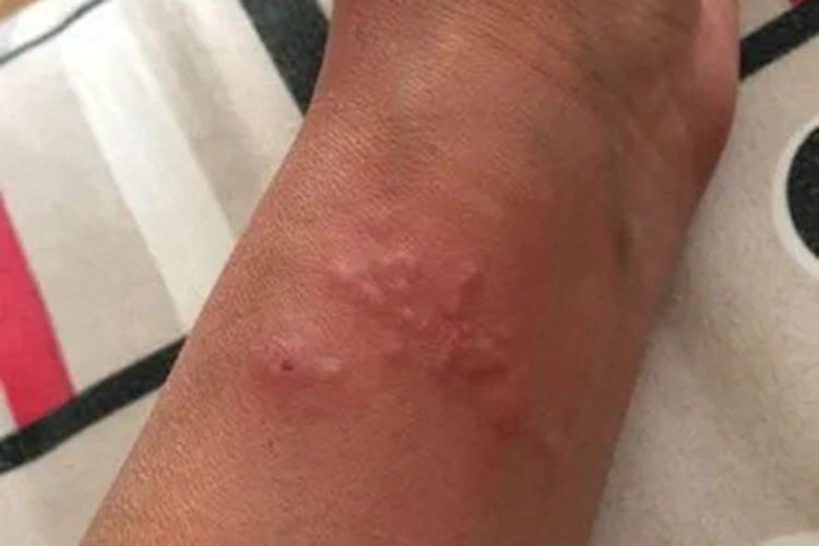 刺胞皮炎手腕起红疙瘩图