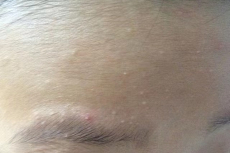 原发性粟丘疹小疙瘩图