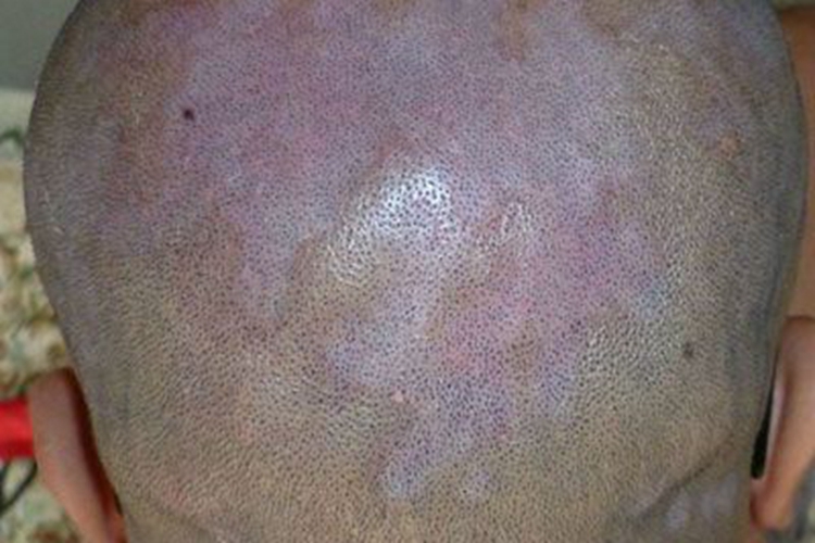 掌黑癣头皮症状图