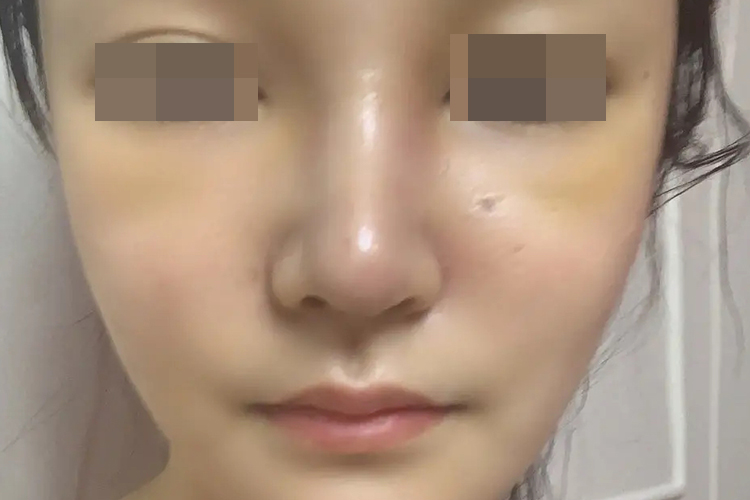 隆鼻拆线后山根又宽又肿图