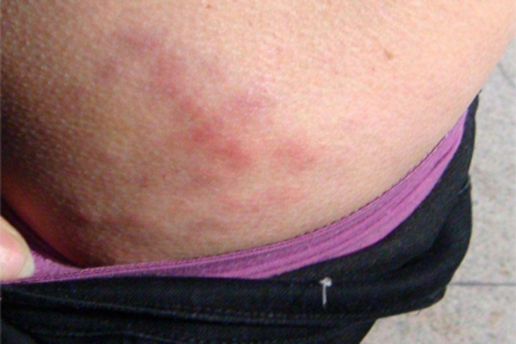 人工性脂膜炎臀部症状图