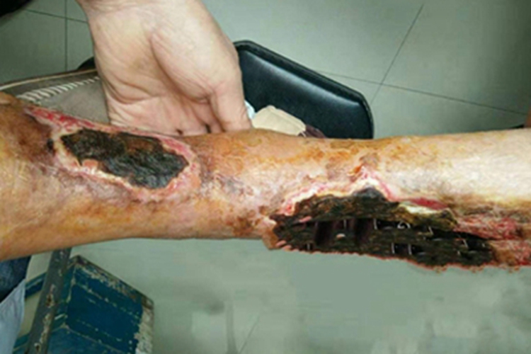 干性坏疽症状图