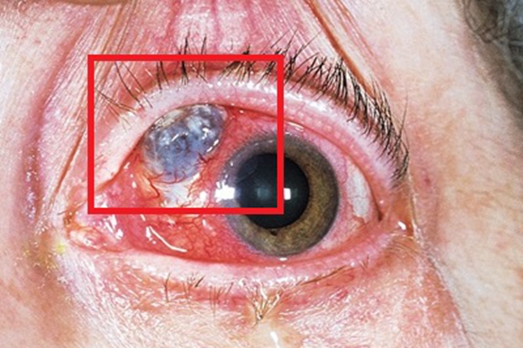 坏死性前巩膜炎疙瘩图