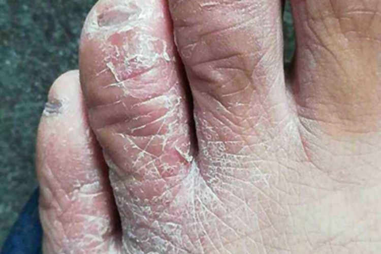 维生素A过多症脚趾症状图 维生素A过多症脚趾症状图
