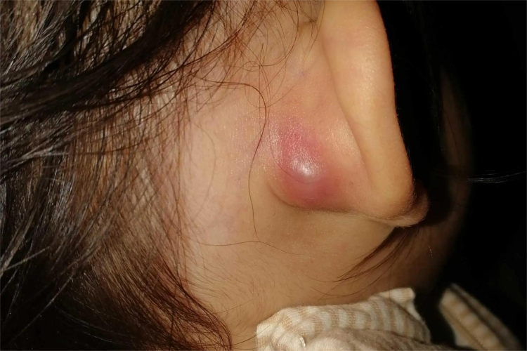 耳朵后面表皮囊肿图
