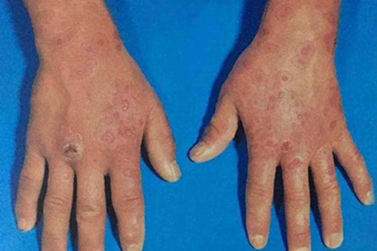 寒冷性多形红斑手背症状图